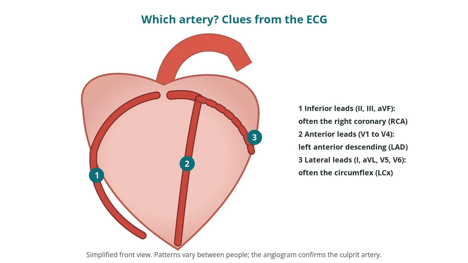 Front-view heart diagram linking ECG lead groups to arteries: anterior leads to the left anterior descending artery, inferior leads to the right coronary artery, lateral leads to the circumflex