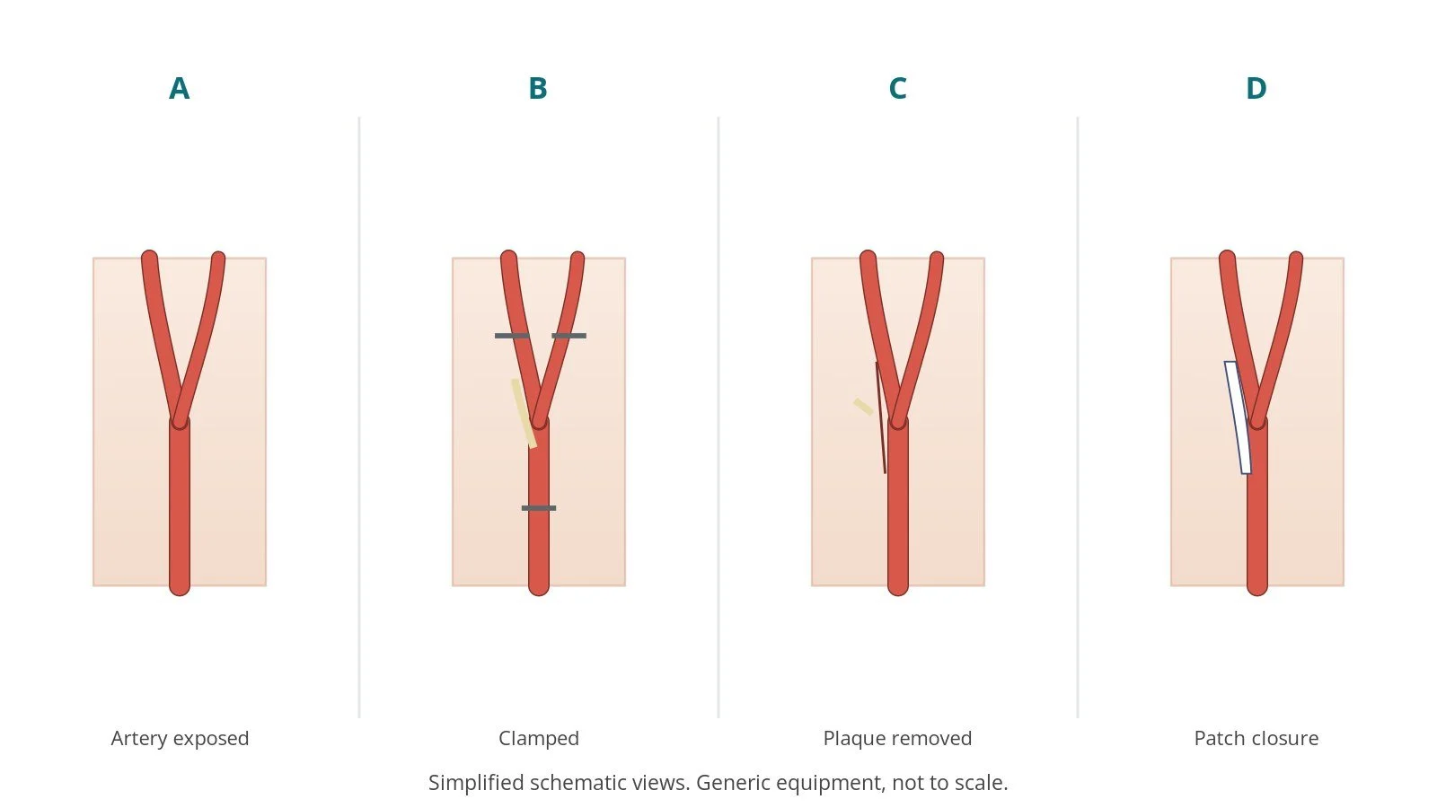 Four-panel schematic of carotid endarterectomy: artery exposed, clamped, plaque removed, patch closure
