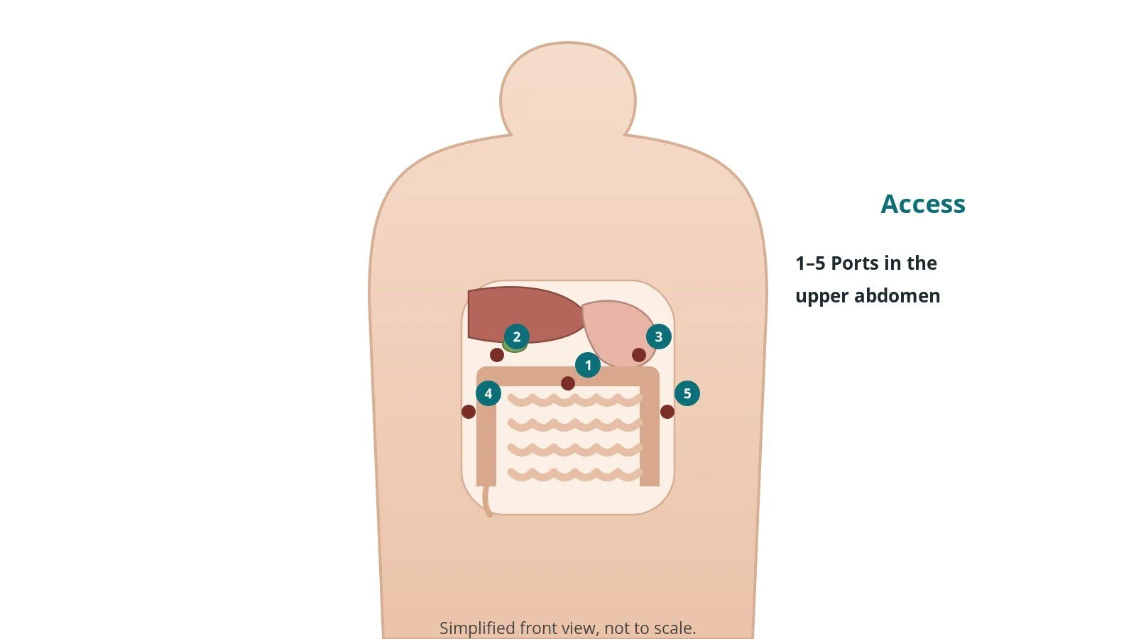Front view of a patient showing five keyhole port sites in the upper abdomen