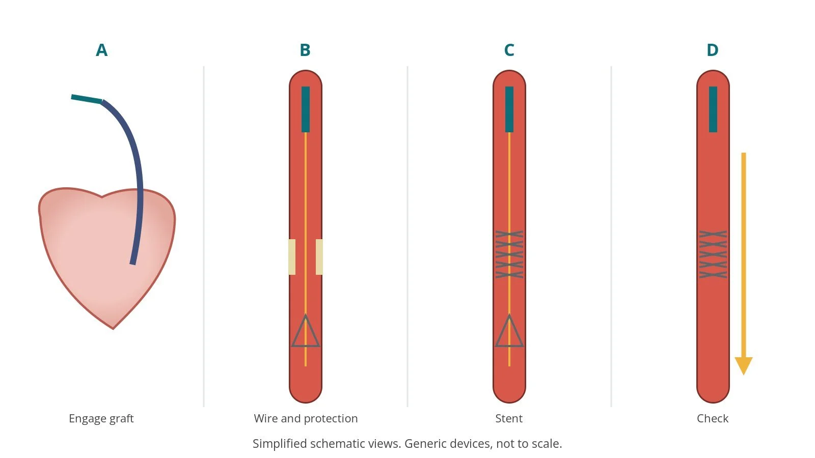 Four-panel schematic of bypass graft stenting: engage graft, wire and protection, stent, check