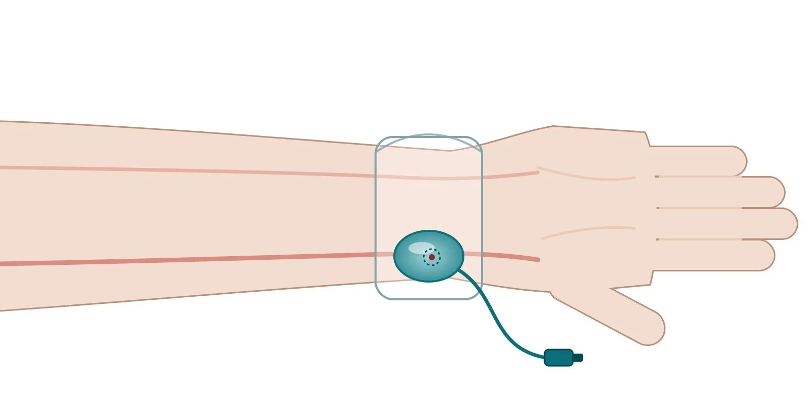 Diagram of a compression band on the wrist after radial PCI
