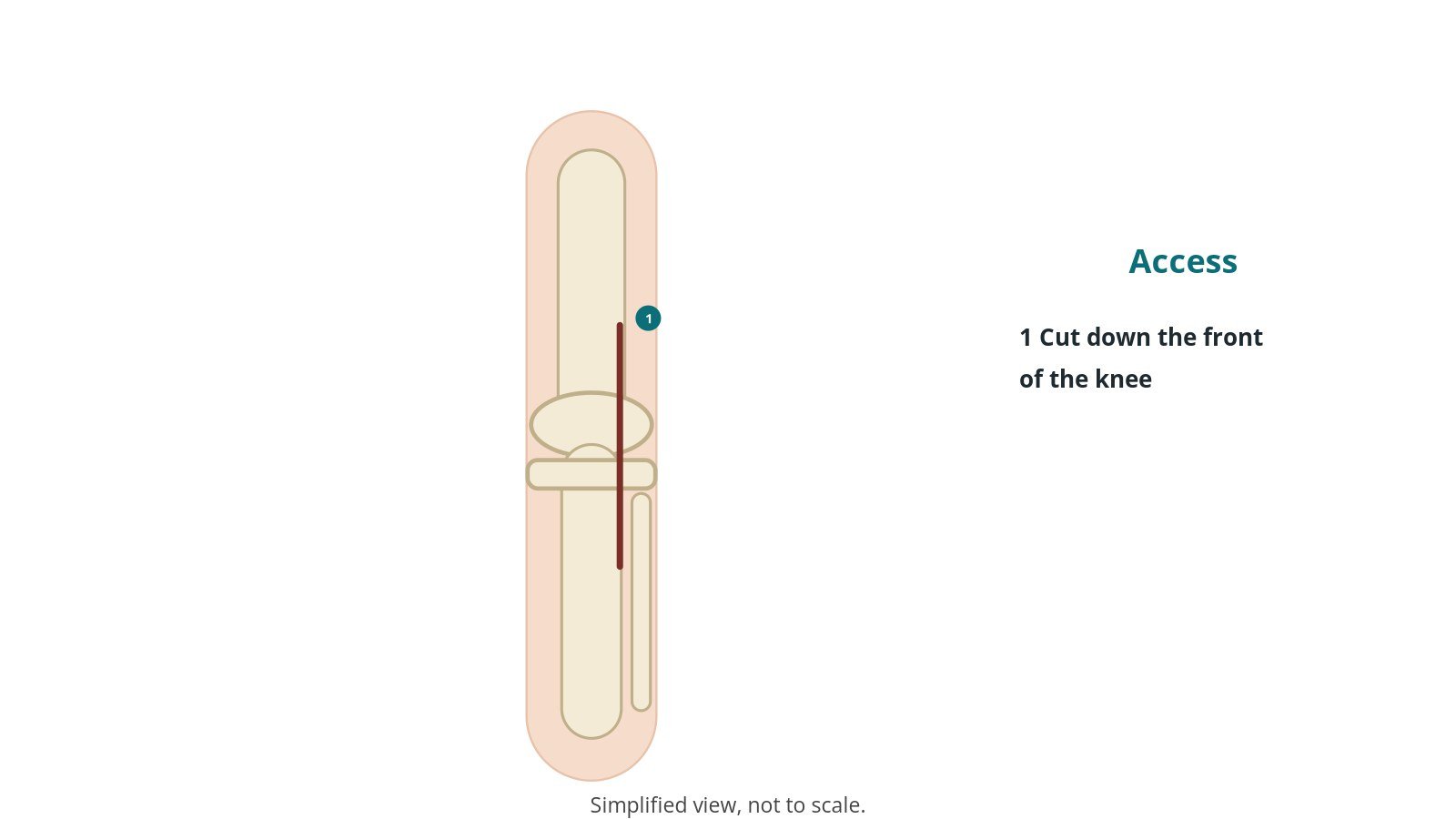 Front view of a knee showing the line of an incision down the front of the knee