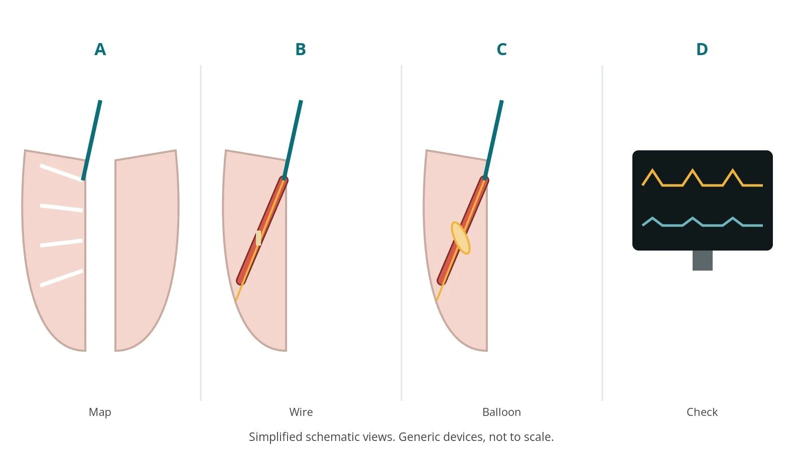 Four-panel schematic of pulmonary artery angioplasty: map, wire, balloon, check