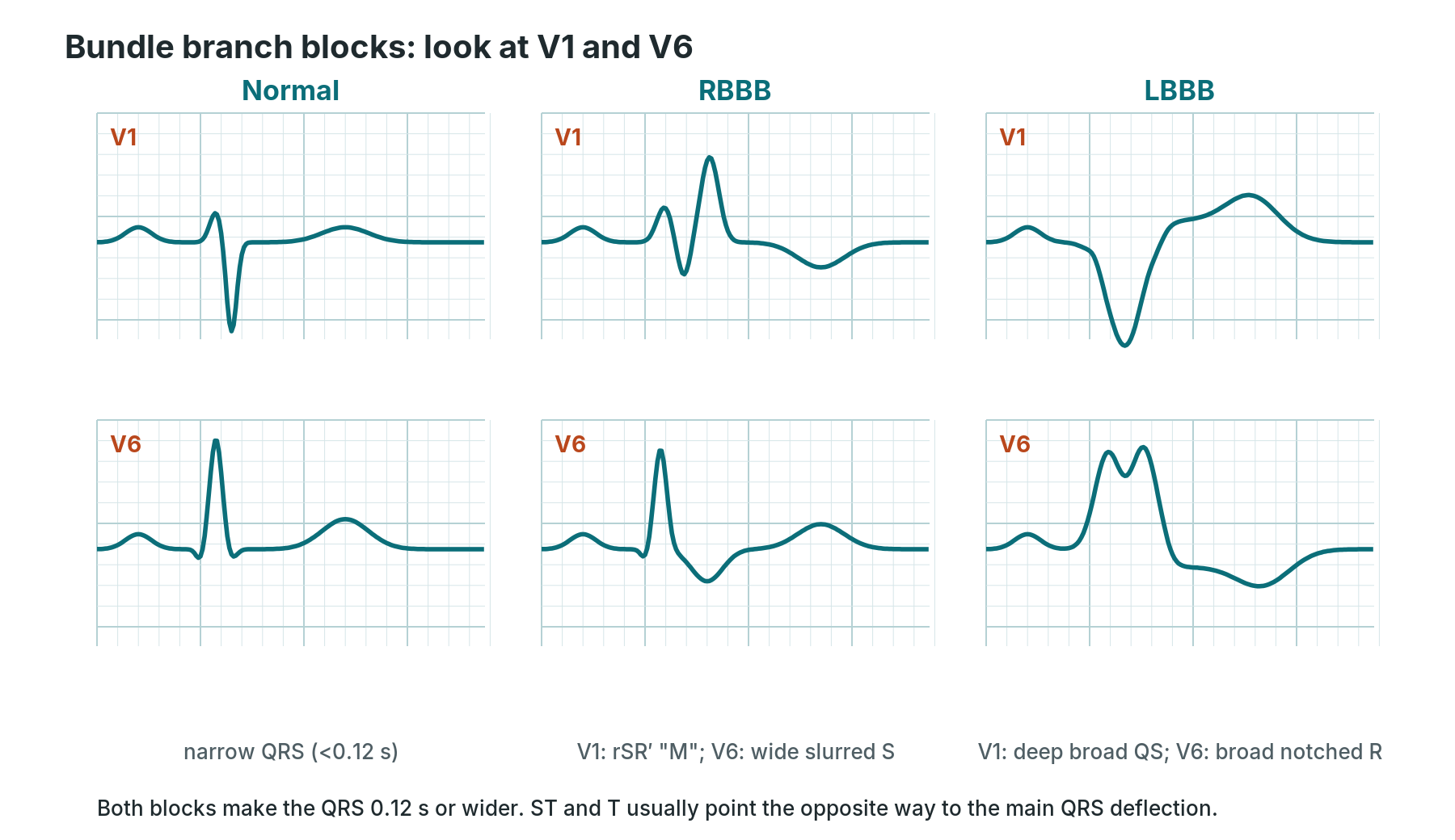 Comparison of normal, right bundle branch block and left bundle branch block complexes in leads V1 and V6