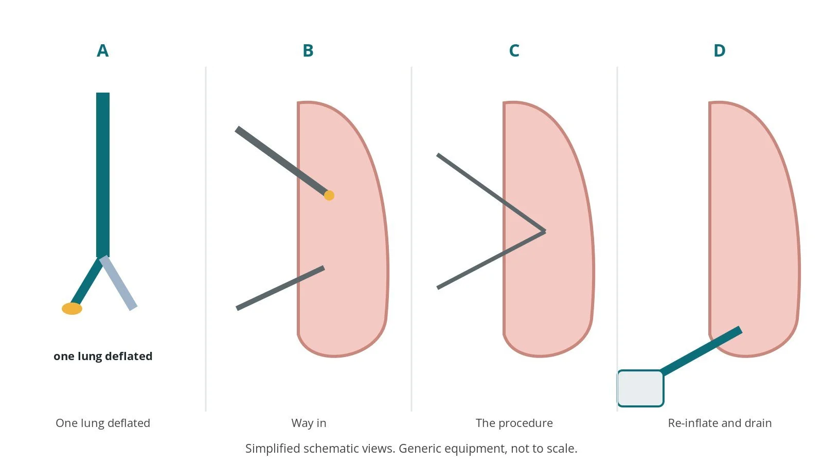 Four-panel schematic of thoracotomy or VATS: one lung deflated, way in, the procedure, re-inflate and drain