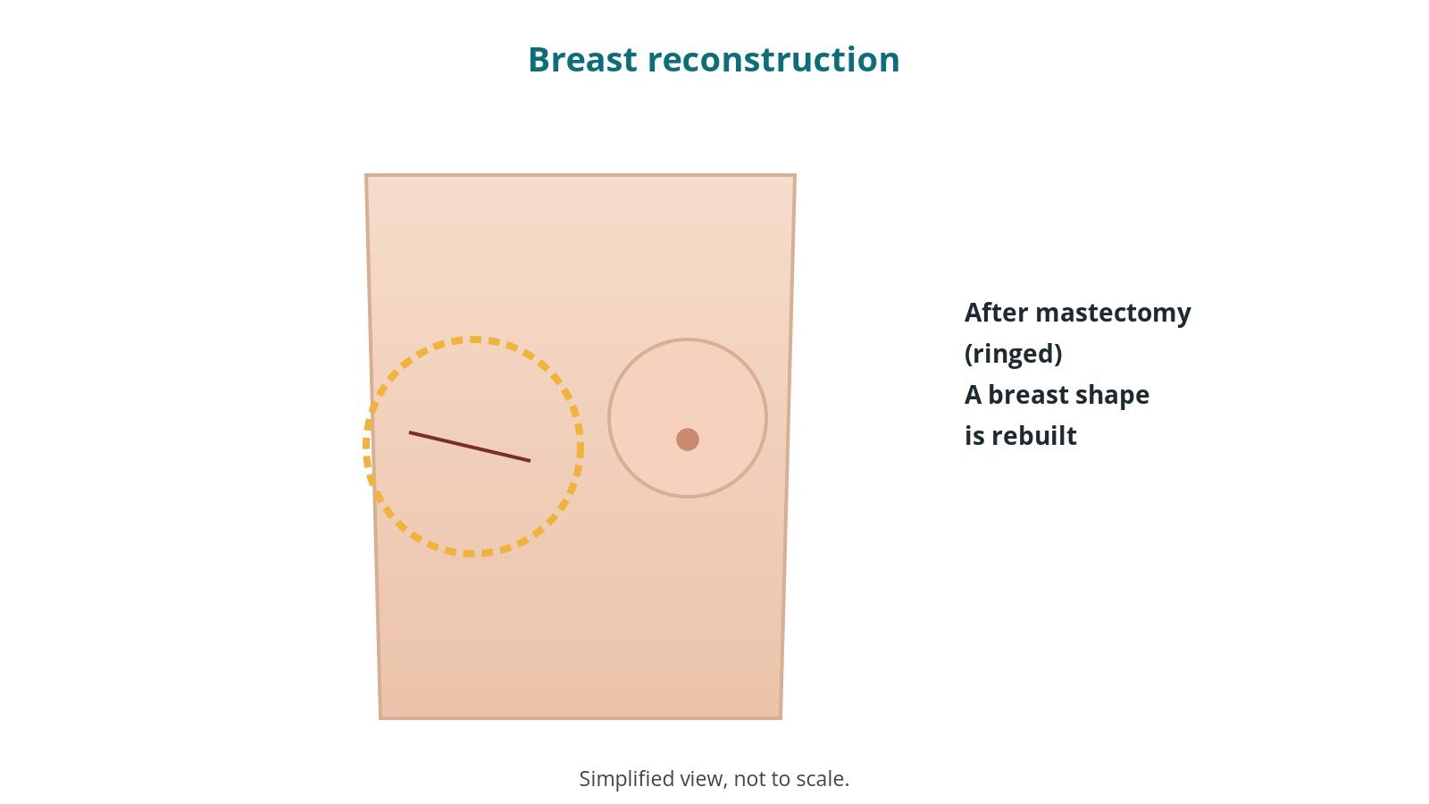 Simplified outline diagram of the chest after mastectomy on one side, ringed