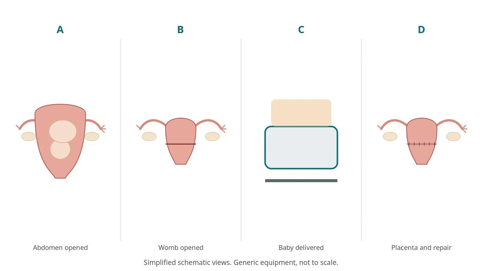 Four-panel schematic of caesarean section: abdomen opened, womb opened, baby delivered, placenta and repair