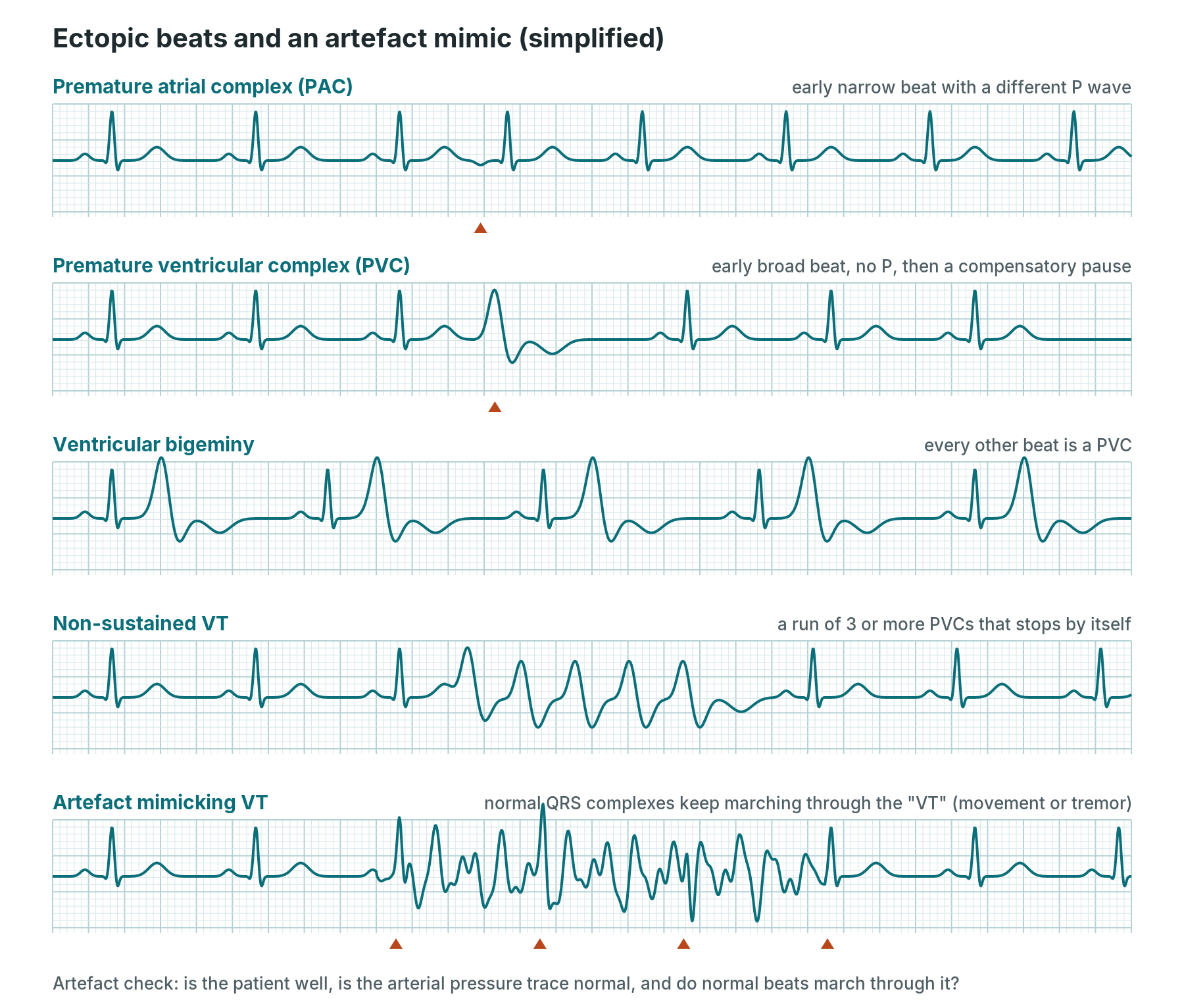 Simplified strips of a premature atrial complex, a premature ventricular complex, ventricular bigeminy, non-sustained VT and movement artefact that mimics VT