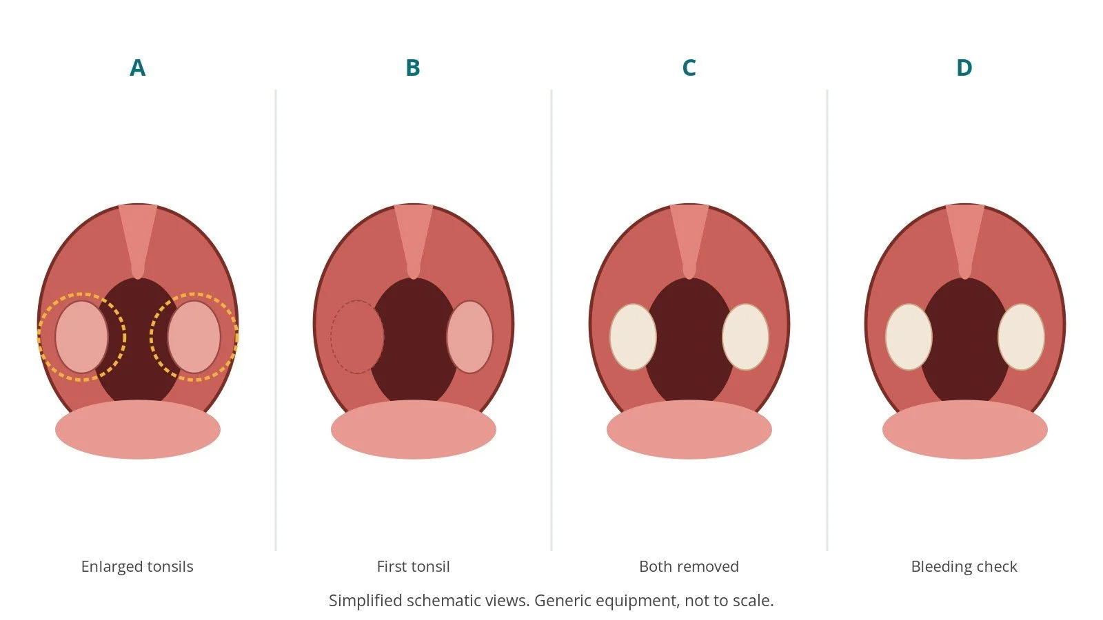 Four-panel schematic of tonsillectomy: enlarged tonsils, first tonsil, both removed, bleeding check