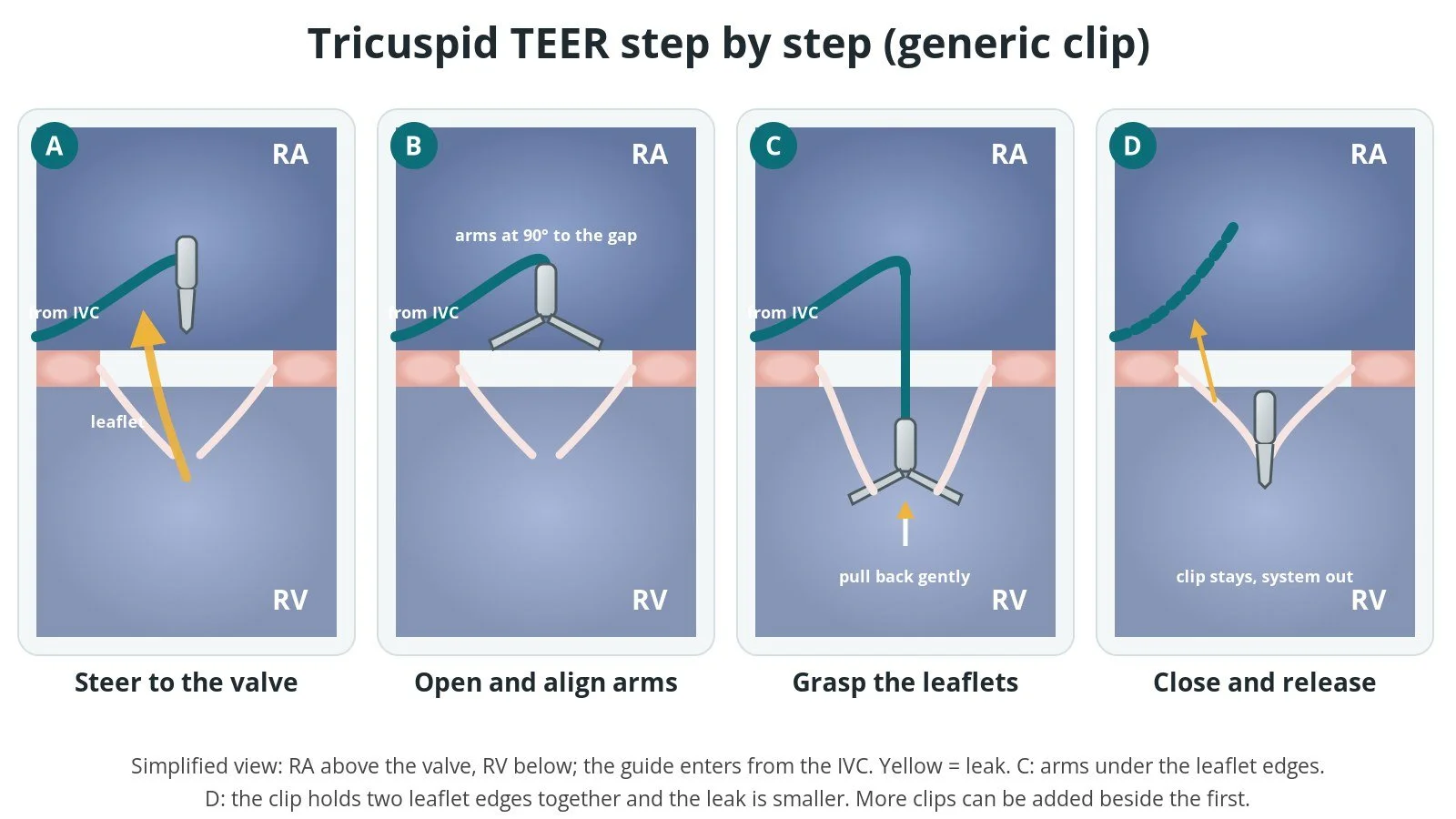 Step-by-step diagram of tricuspid TEER: steer, align, grasp the leaflets and release the clip