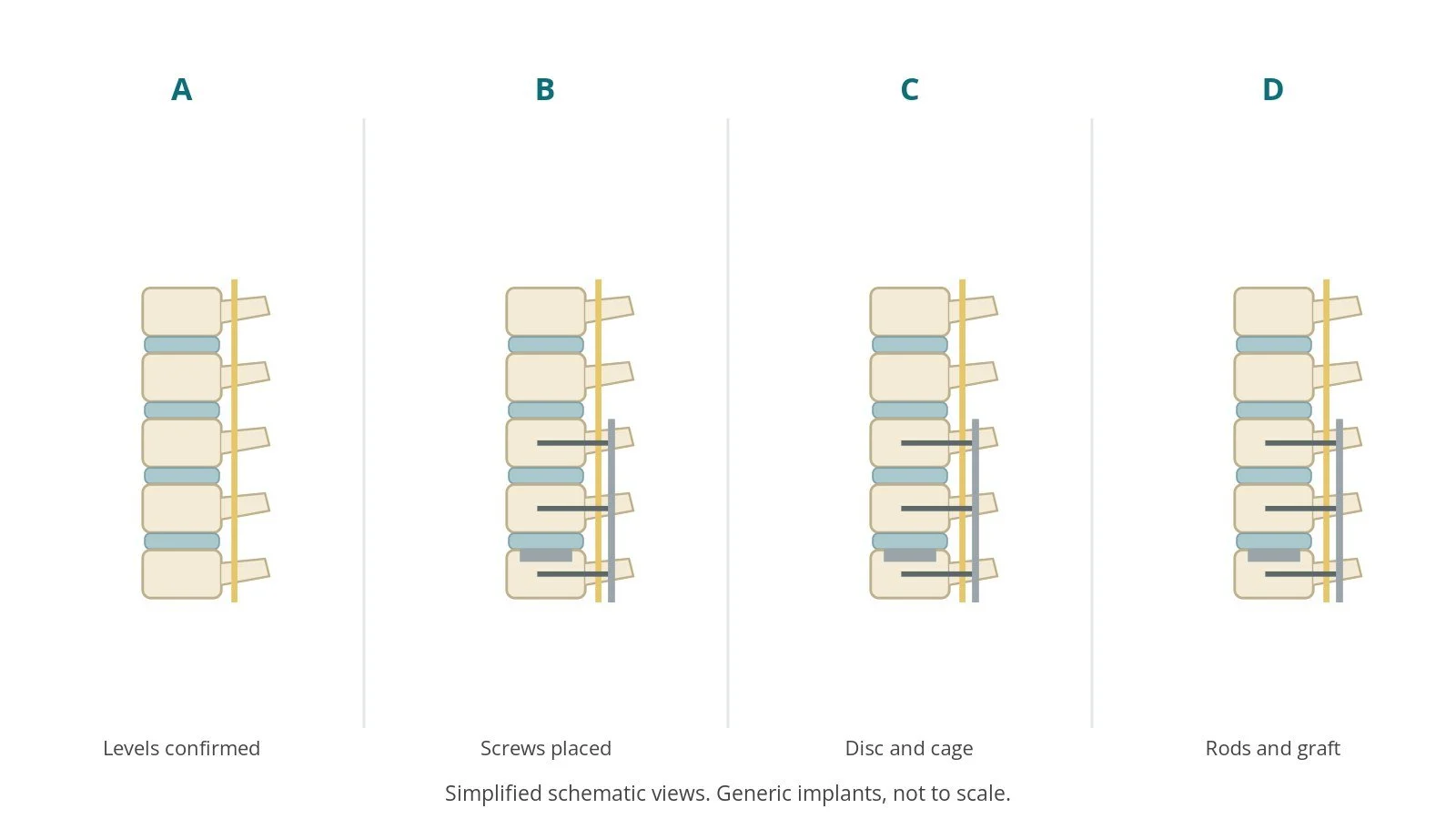 Four-panel schematic of spinal fusion: levels confirmed, screws placed, disc and cage, rods and graft
