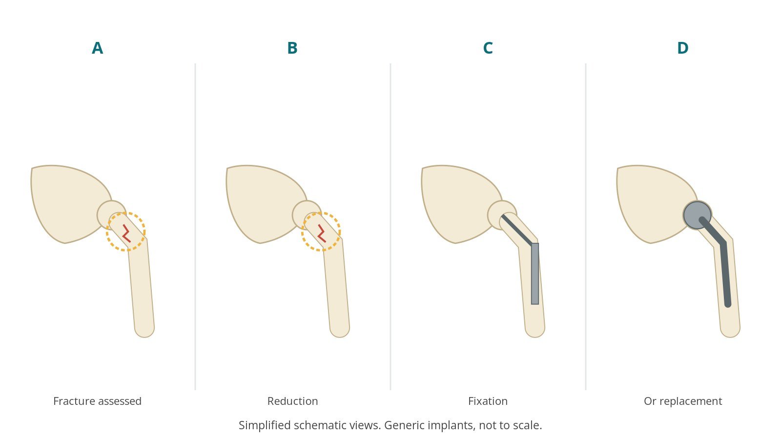 Four-panel schematic of hip fracture repair: fracture assessed, reduction, fixation, or replacement