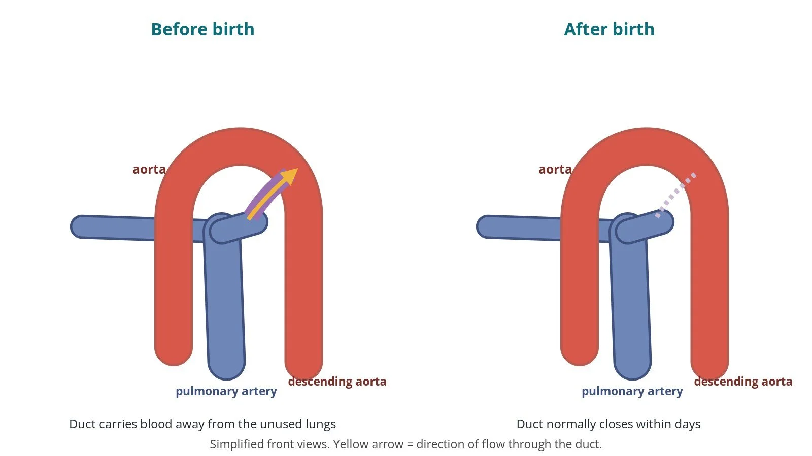 Two diagrams comparing blood flow through the ductus arteriosus before birth, from pulmonary artery to aorta, and after birth when it normally closes