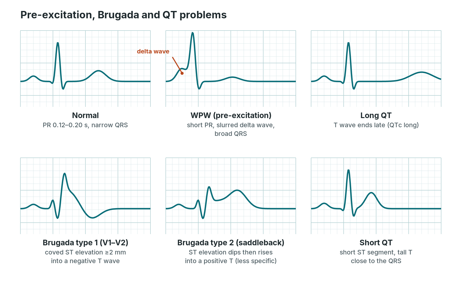 Six simplified beats: normal, WPW with delta wave, long QT, Brugada type 1 coved pattern, Brugada type 2 saddleback pattern and short QT