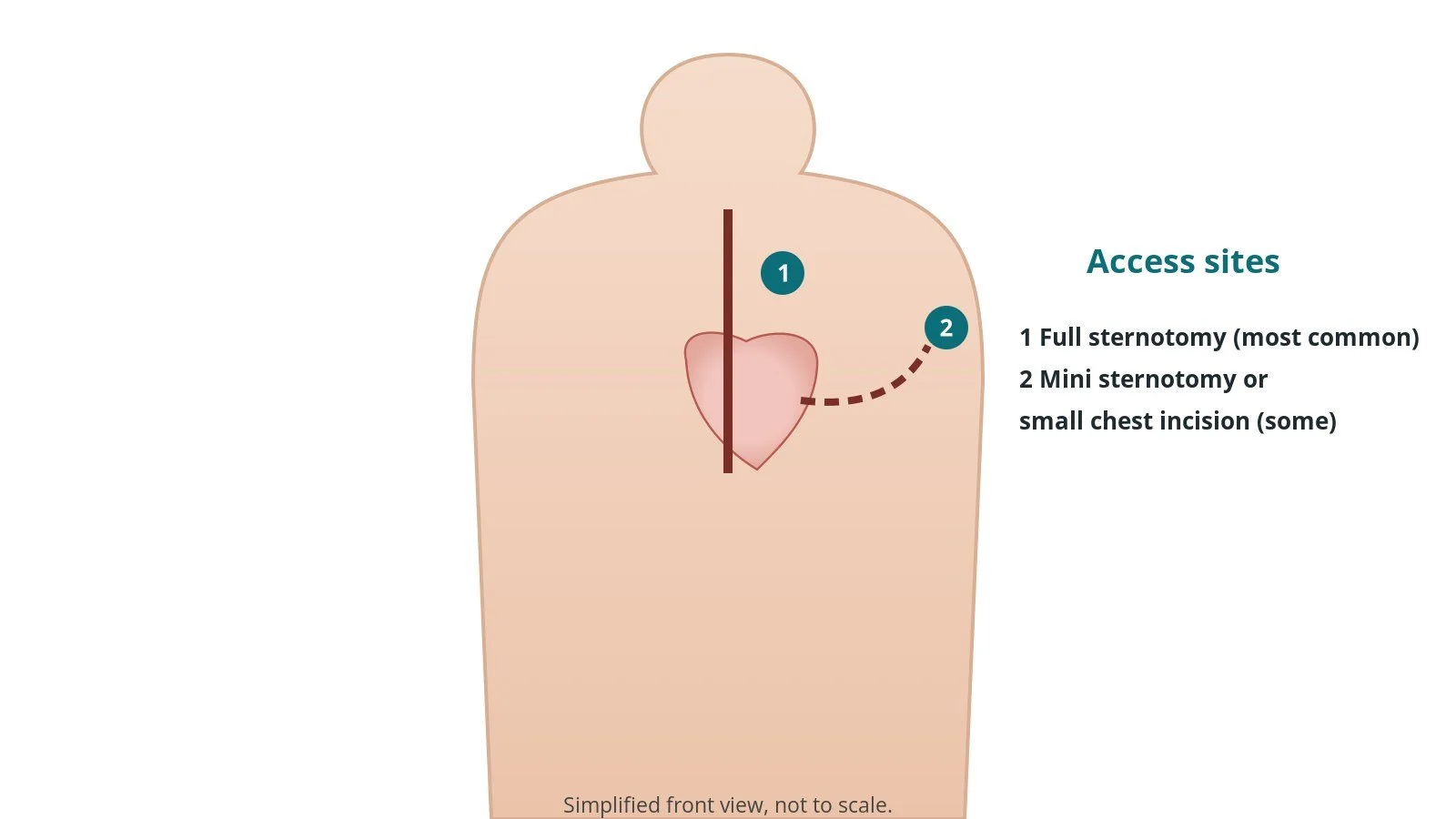 Front view of a patient showing a full breastbone incision and a smaller alternative incision for aortic valve surgery