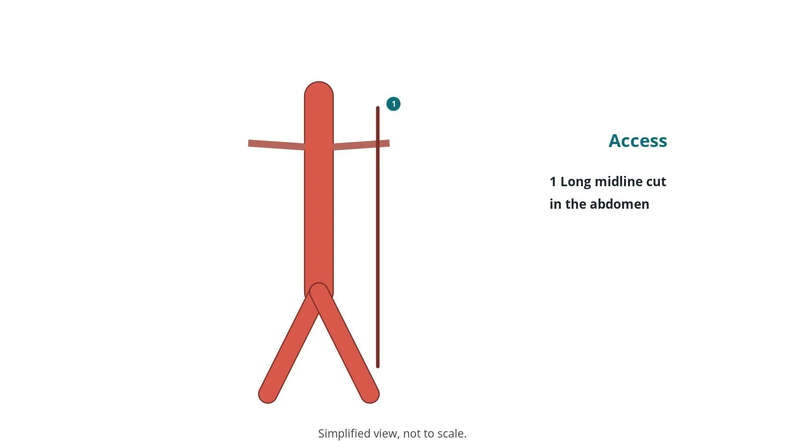 Diagram of the abdominal aorta showing a long vertical midline incision over it