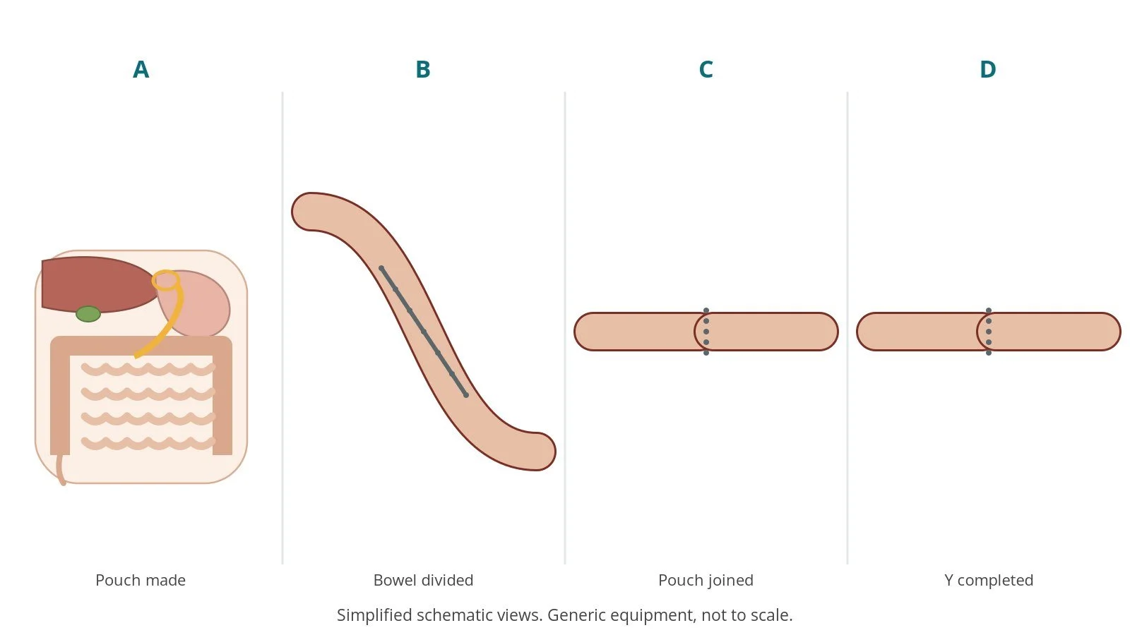 Four-panel schematic of gastric bypass: pouch made, bowel divided, pouch joined, y completed