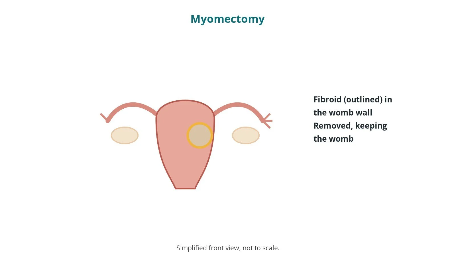 Diagram of the womb with a round fibroid in its wall, outlined