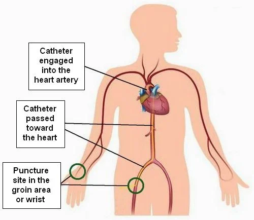 Coronary Angiogram Rodnie Oro