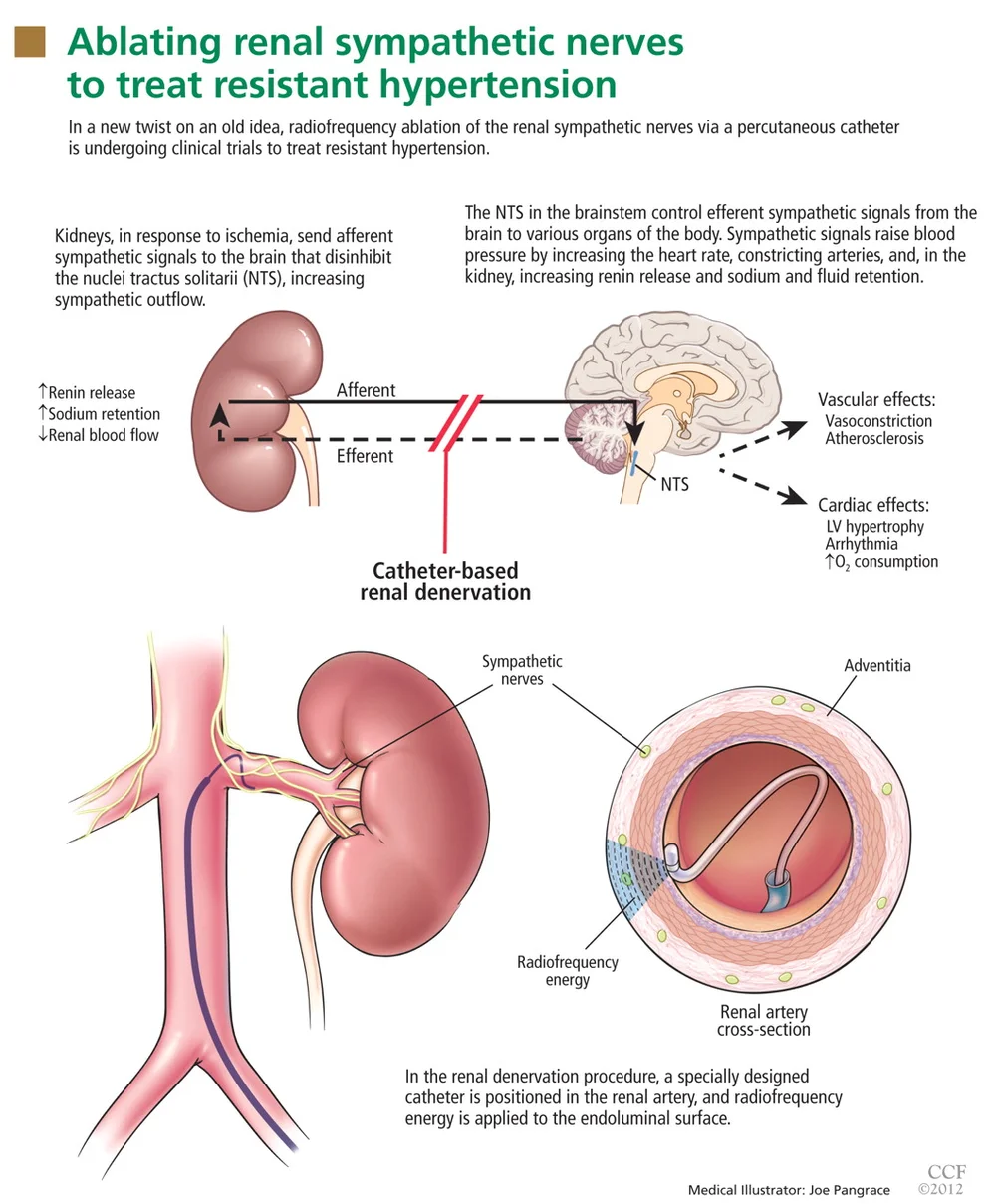 Renal Denervation — Golden Shutter Films