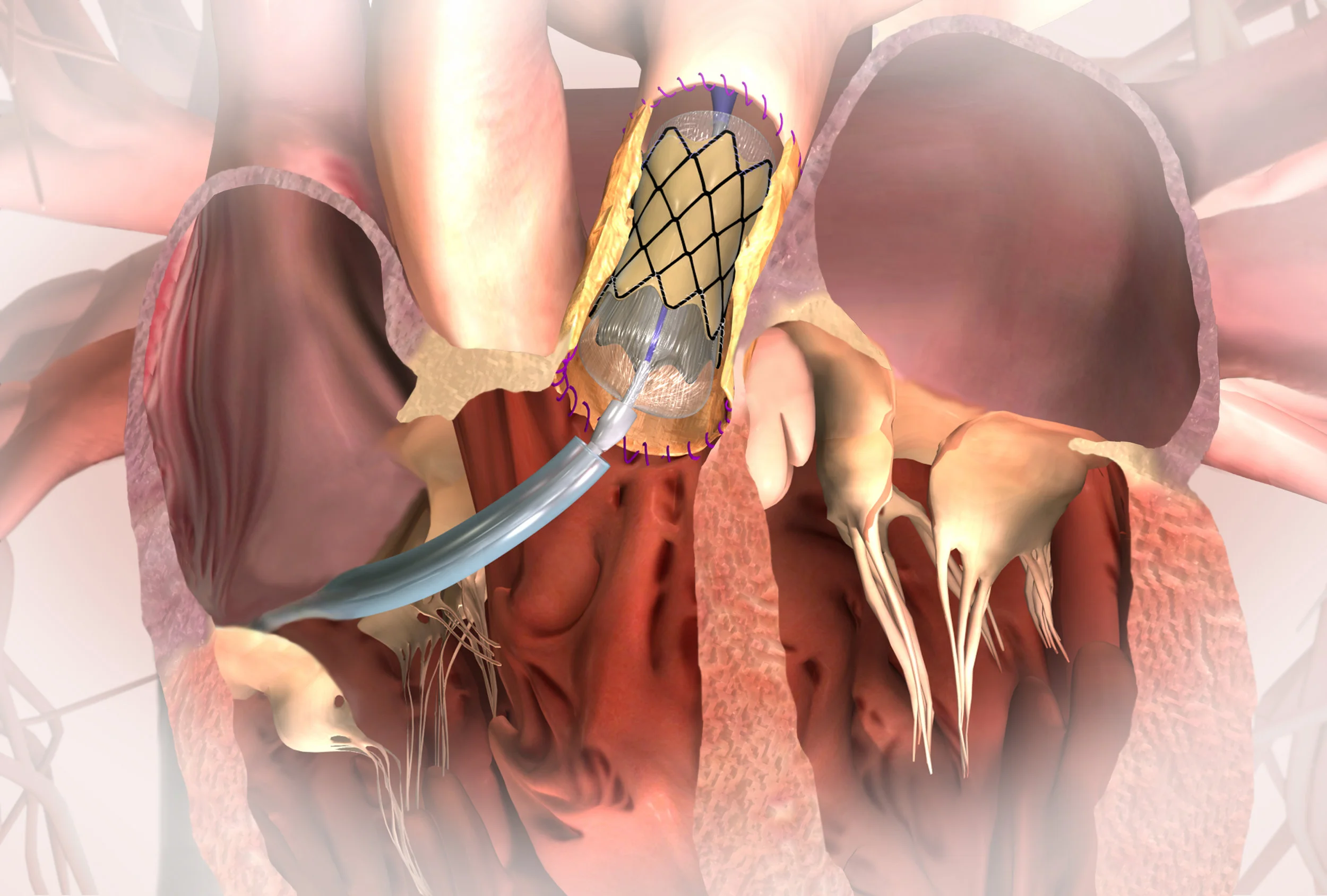 Percutaneous Pulmonary Valve Implantation (PPVI)