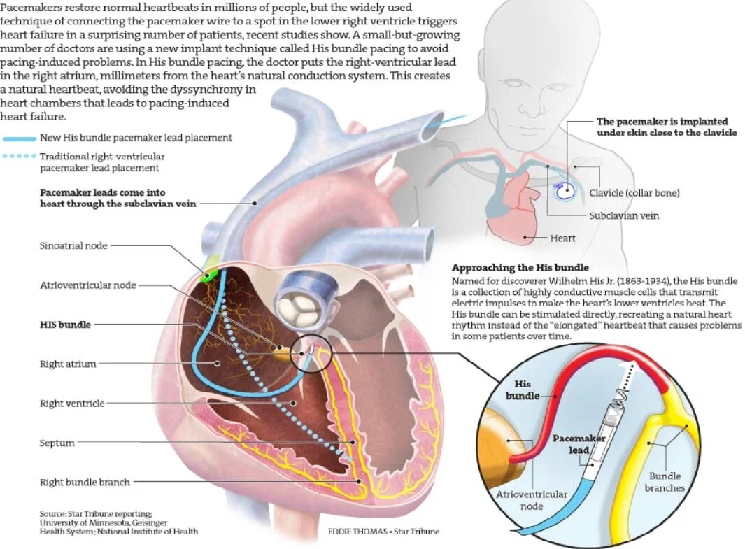 Permanent Pacemaker (PPM, ICD, CRT) — Golden Shutter Films
