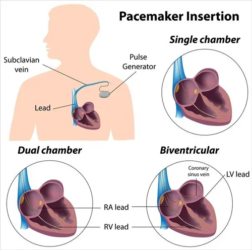 Ptpm Pacemaker Permanent Pacemaker (PPM, ICD, CRT) — Golden Shutter Films