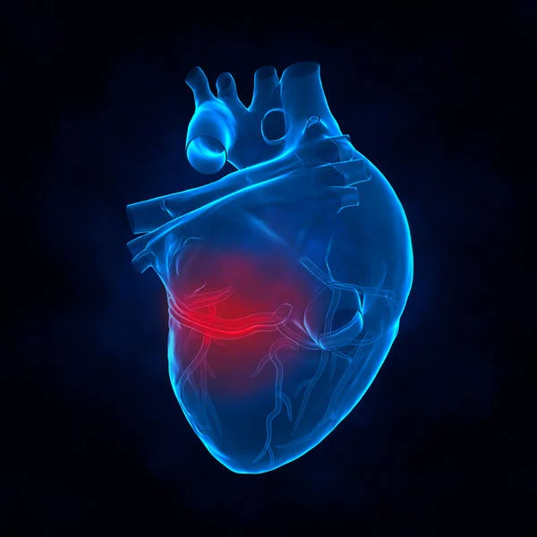 Acute Myocardial Infarction (AMI)