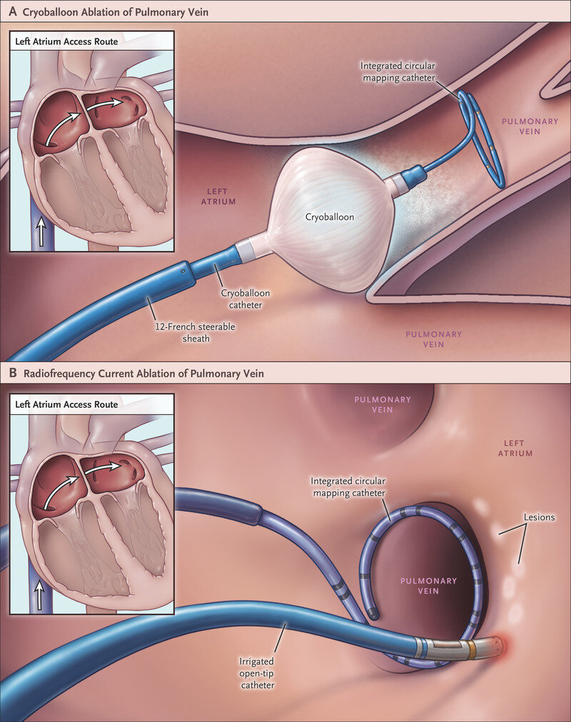 AF (Atrial Fibrillation) CryoAblation