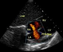 Patent Foramen Ovale (PFO) closure ICE guided