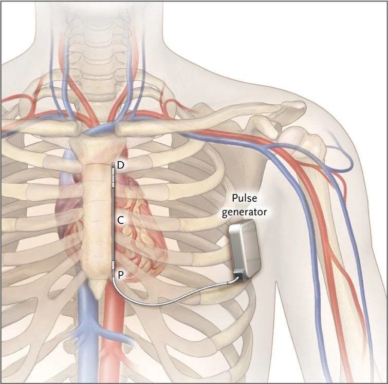 Subcutaneous Implantable Cardiac Defibrillator (S-ICD)