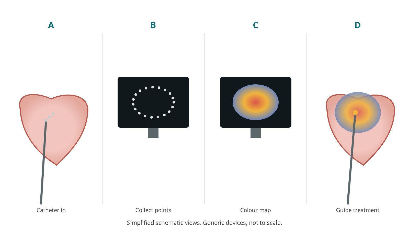 Four-panel schematic of electroanatomical mapping: catheter in, collect points, colour map, guide treatment
