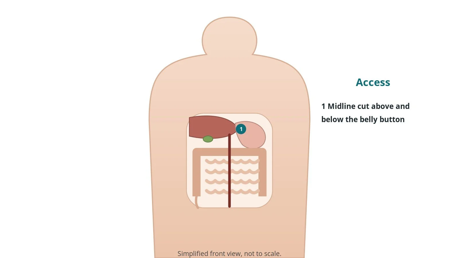 Front view of a patient showing a vertical midline incision down the abdomen
