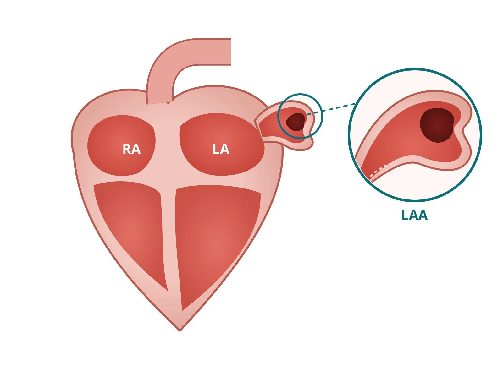 Left atrial appendage occlusion (LAAO): a Cath Lab 101 guide