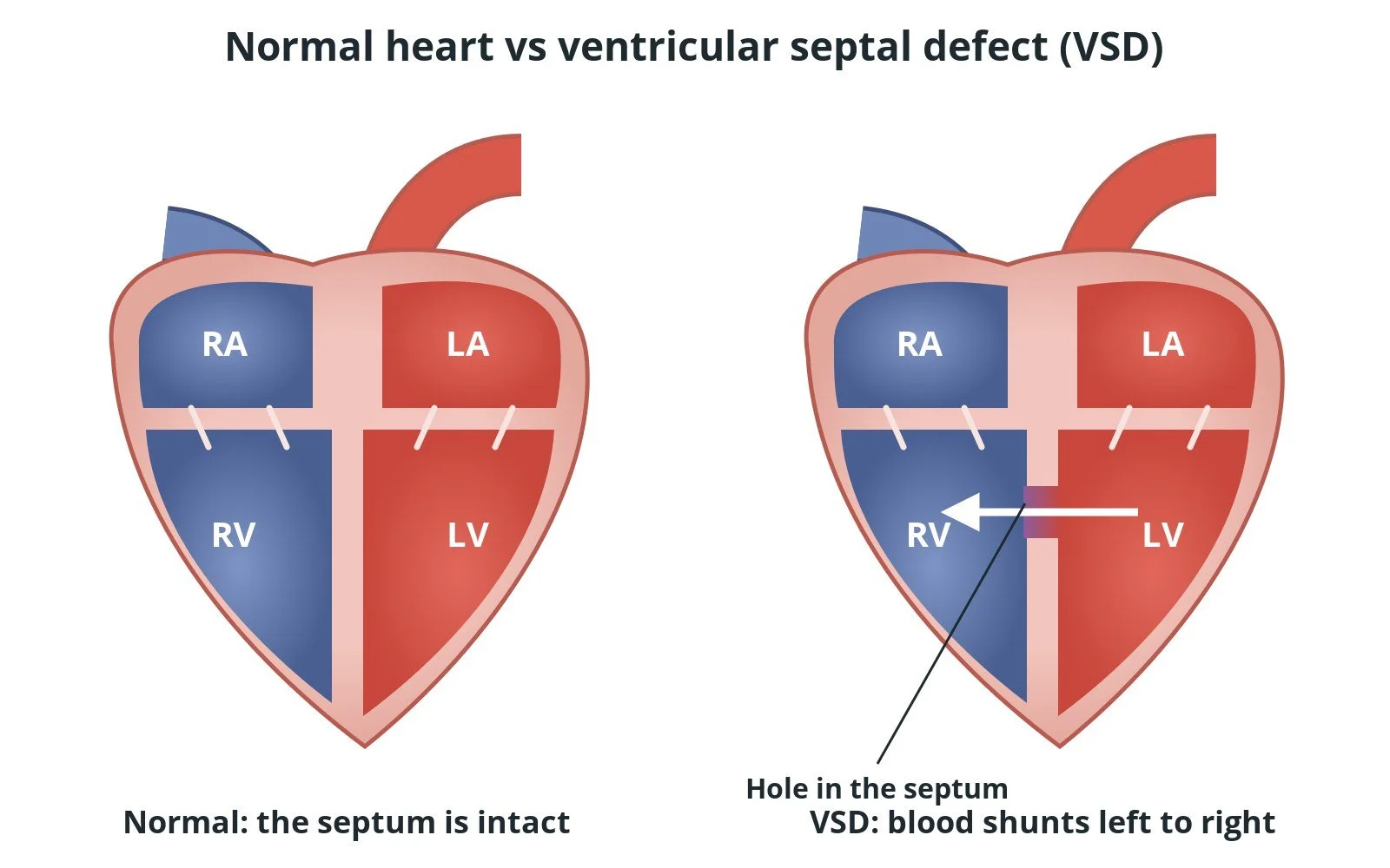 Ventricular septal defect (VSD) closure: a Cath Lab 101 guide