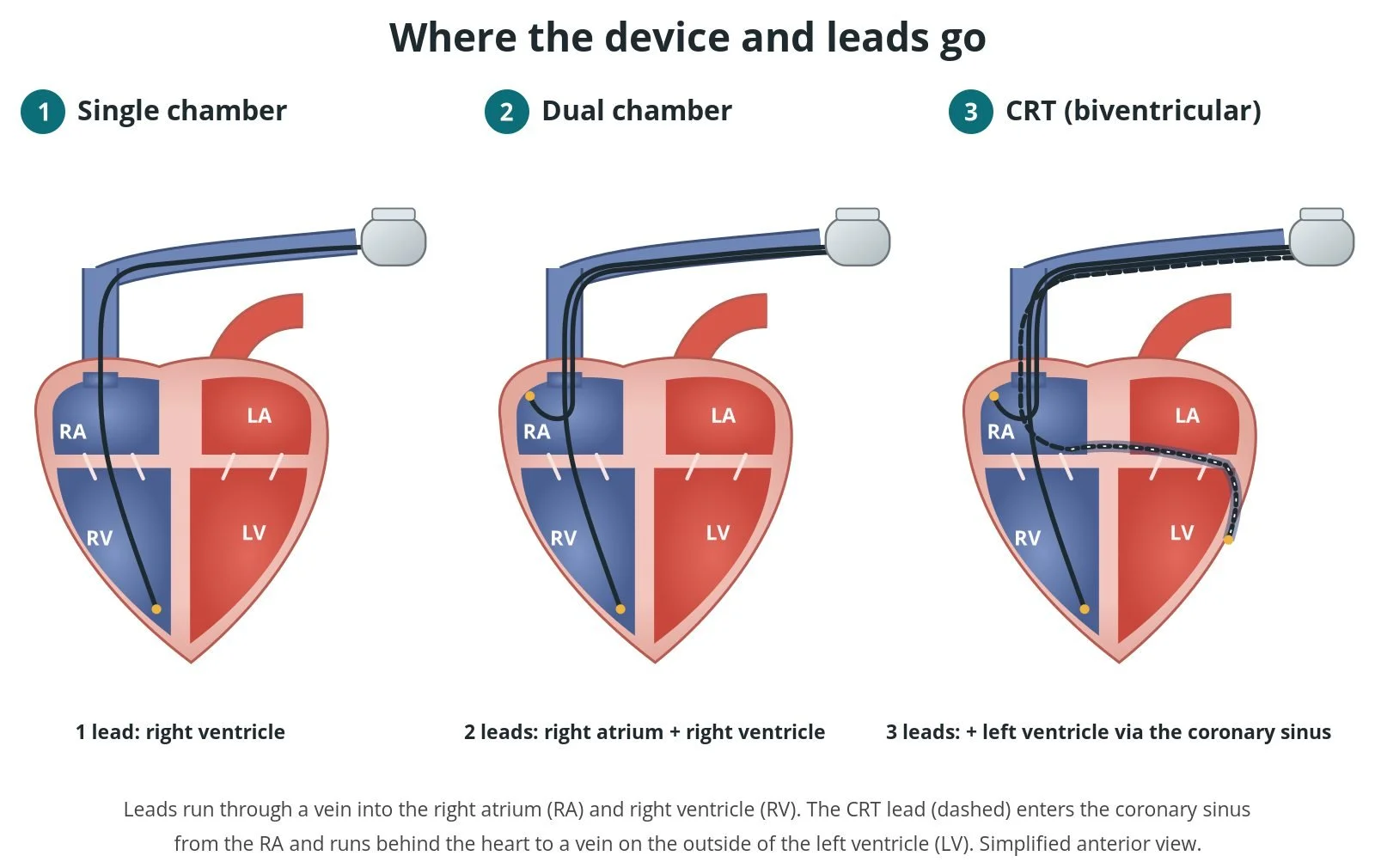 Permanent pacemaker (PPM), ICD and CRT: a Cath Lab 101 guide