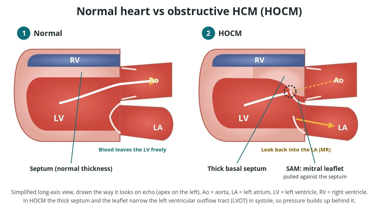 Alcohol septal ablation (ASA) for HOCM: a Cath Lab 101 guide