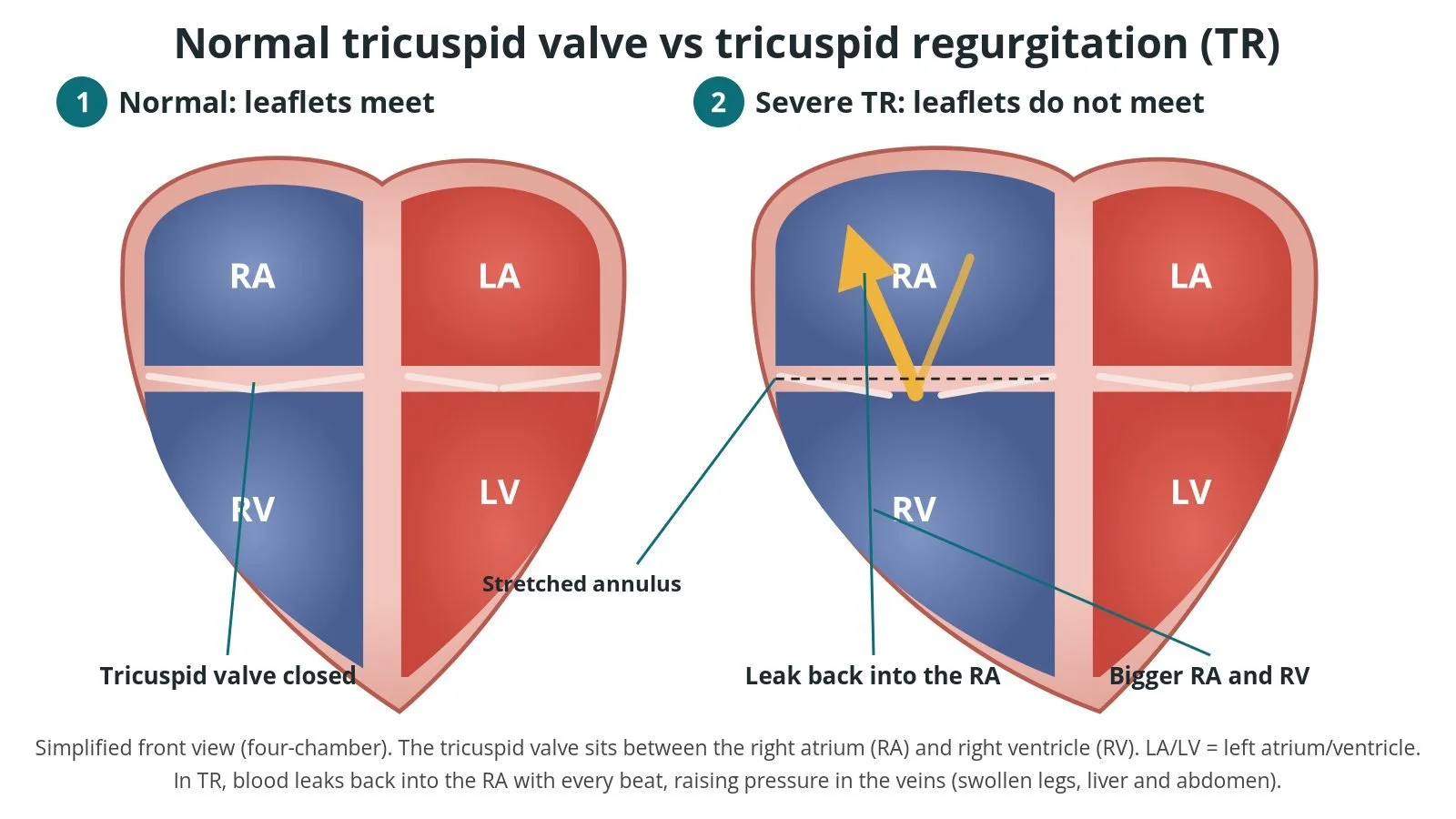 Tricuspid TEER (transcatheter edge-to-edge repair): a Cath Lab 101 guide