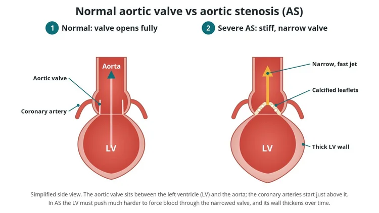 Diagram of a normal aortic valve next to a narrowed one
