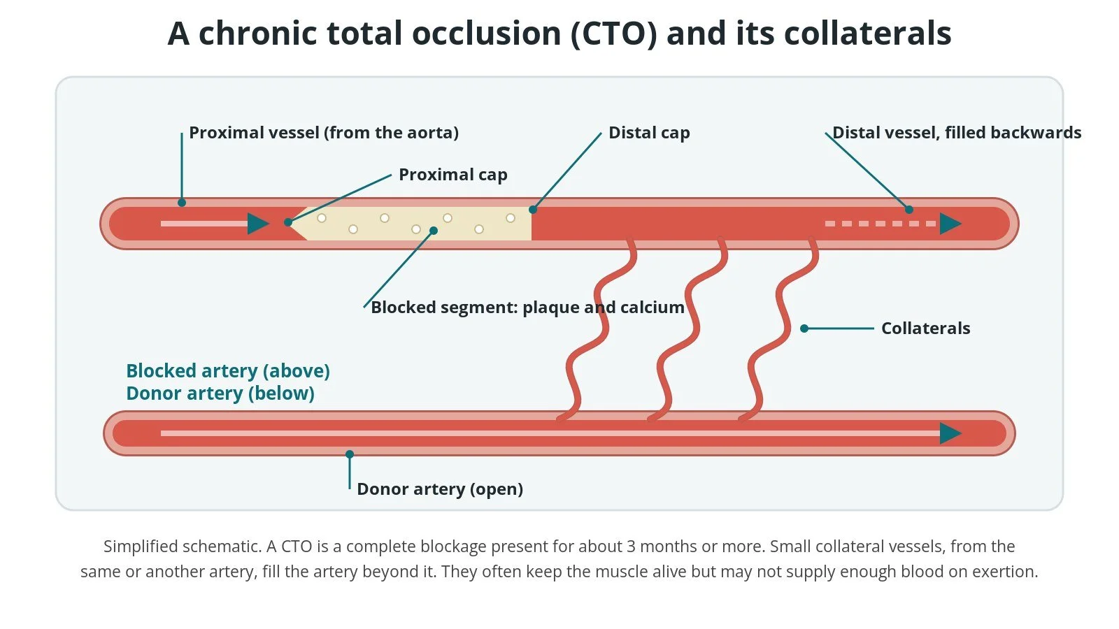 Chronic total occlusion (CTO PCI): a Cath Lab 101 guide