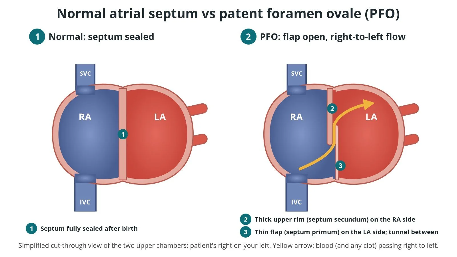 PFO closure (patent foramen ovale): a Cath Lab 101 guide