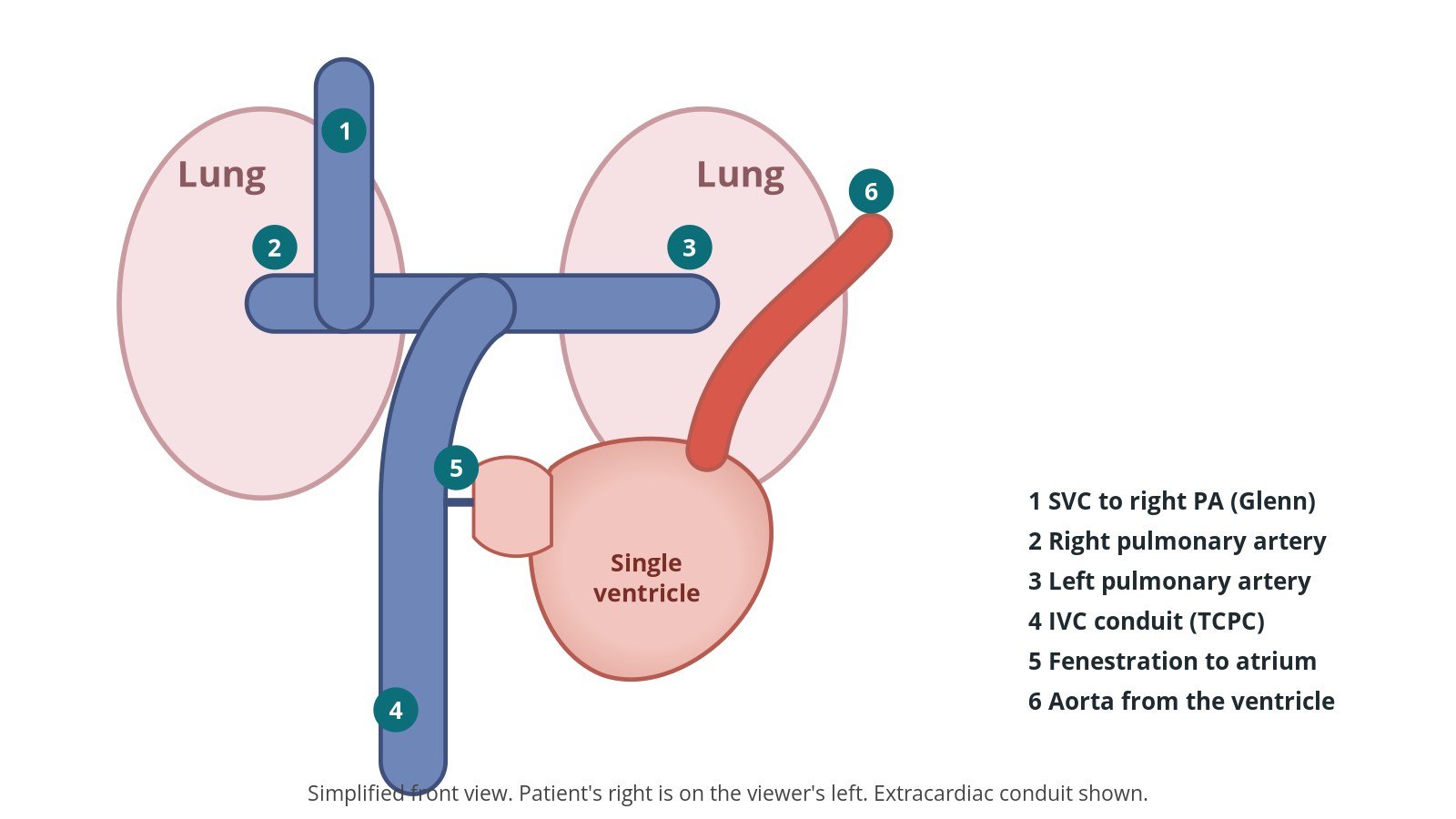 TCPC (Fontan) ballooning and stenting: a Cath Lab 101 guide