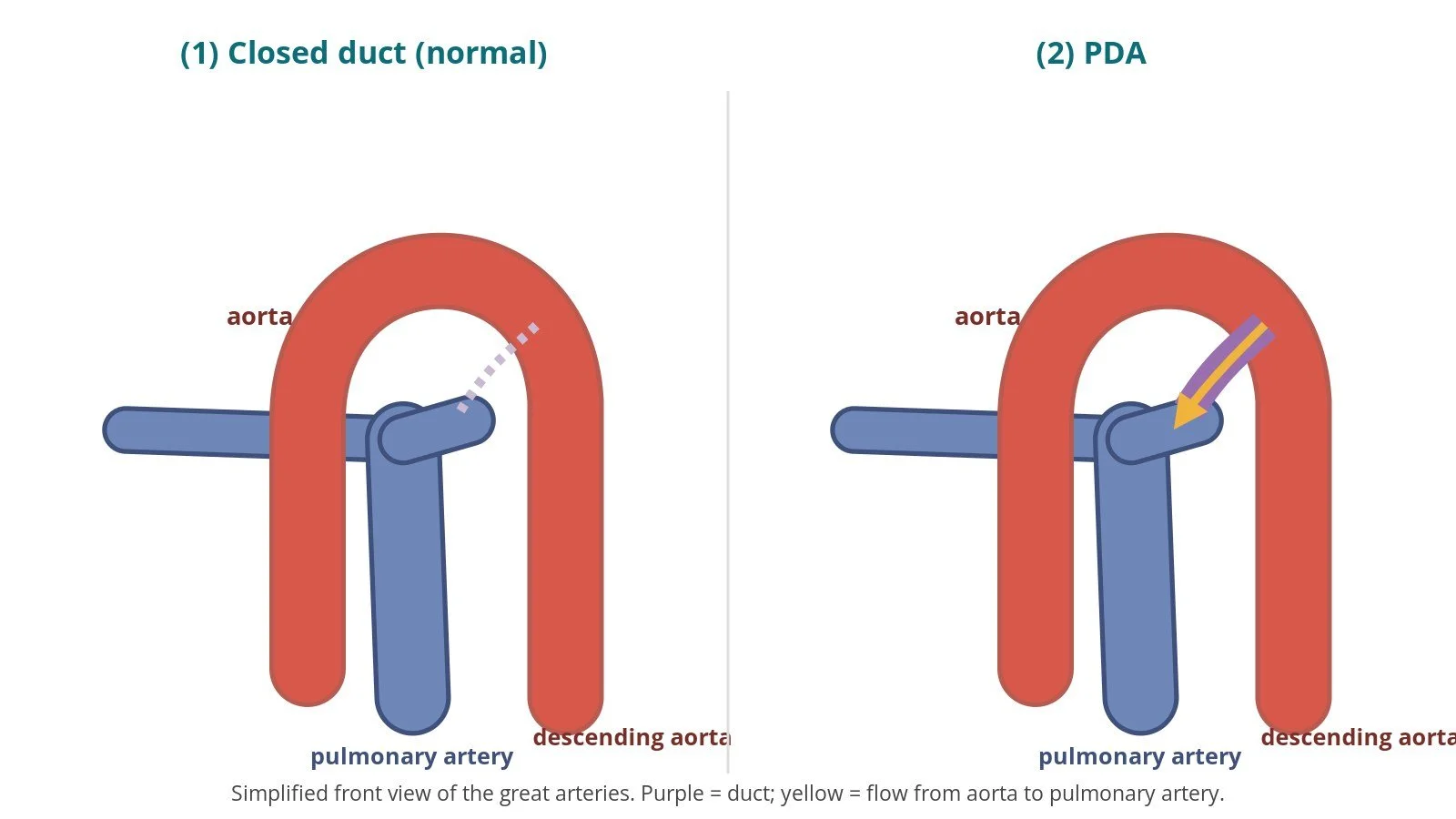 PDA closure (patent ductus arteriosus): a Cath Lab 101 guide