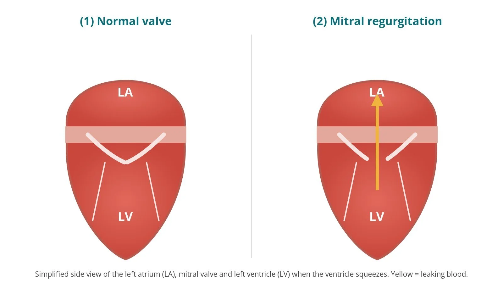 Mitral TEER (transcatheter edge-to-edge repair): a Cath Lab 101 guide