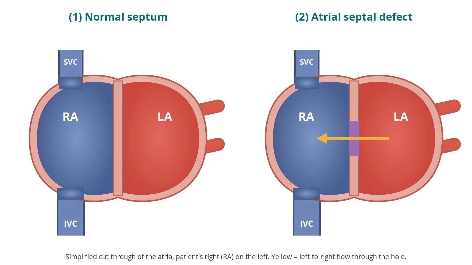 ASD closure (atrial septal defect): a Cath Lab 101 guide