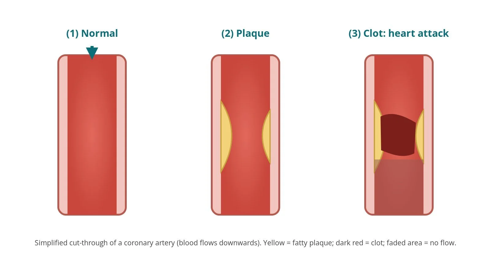 Heart attack (acute MI) and primary PCI: a Cath Lab 101 guide