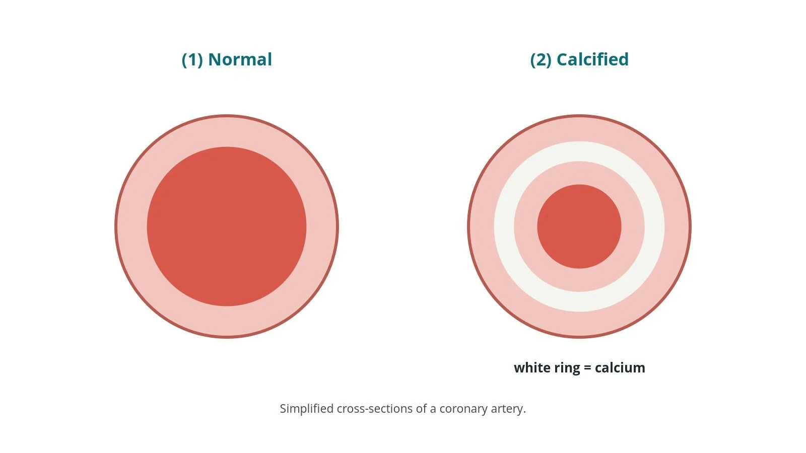 Intravascular lithotripsy (IVL) for calcified arteries: a Cath Lab 101 guide