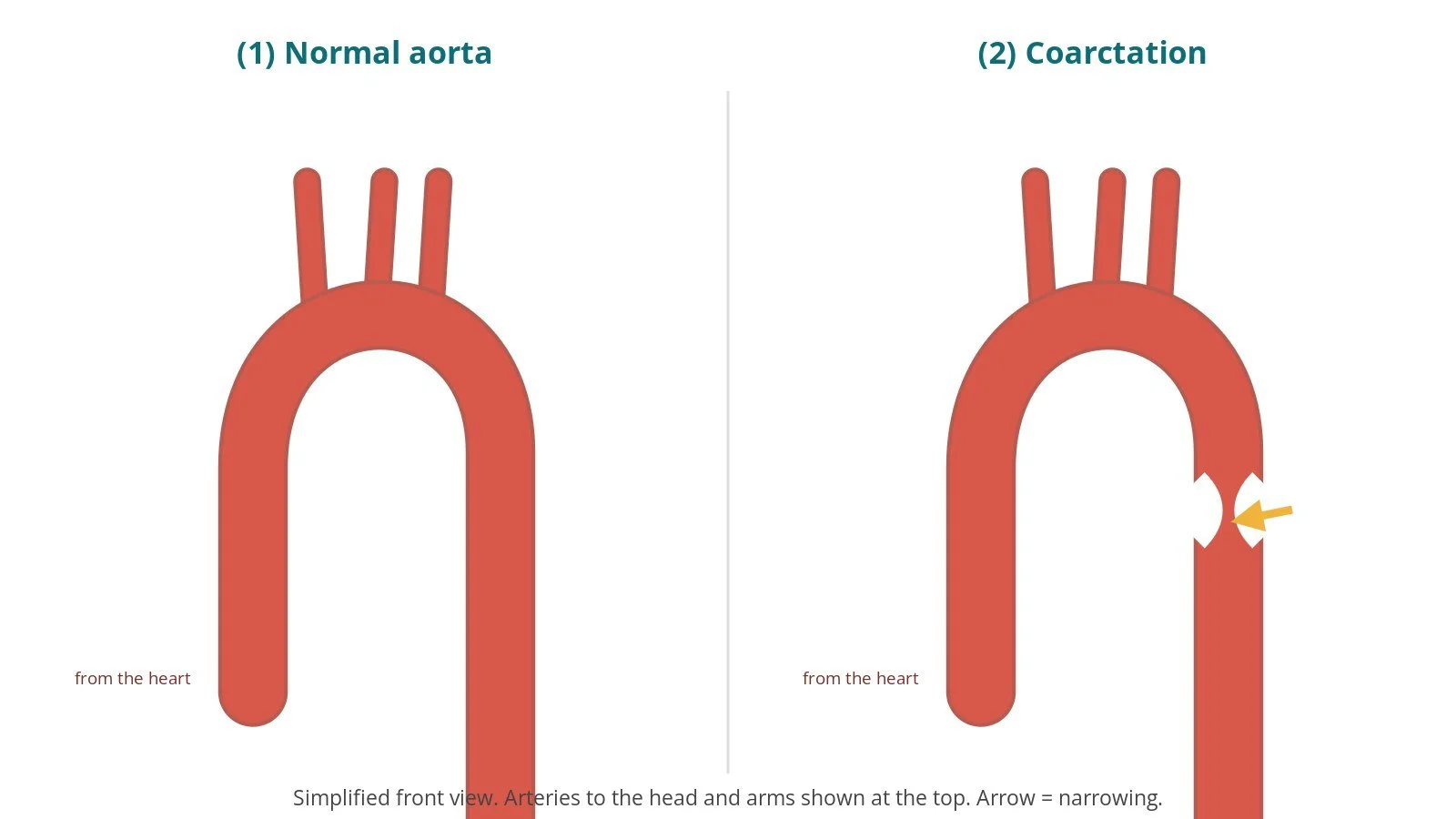 Coarctation of the aorta stenting: a Cath Lab 101 guide