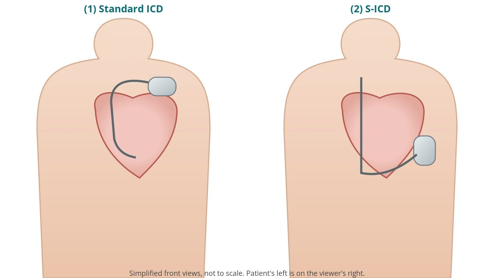 Subcutaneous ICD (S-ICD): a Cath Lab 101 guide