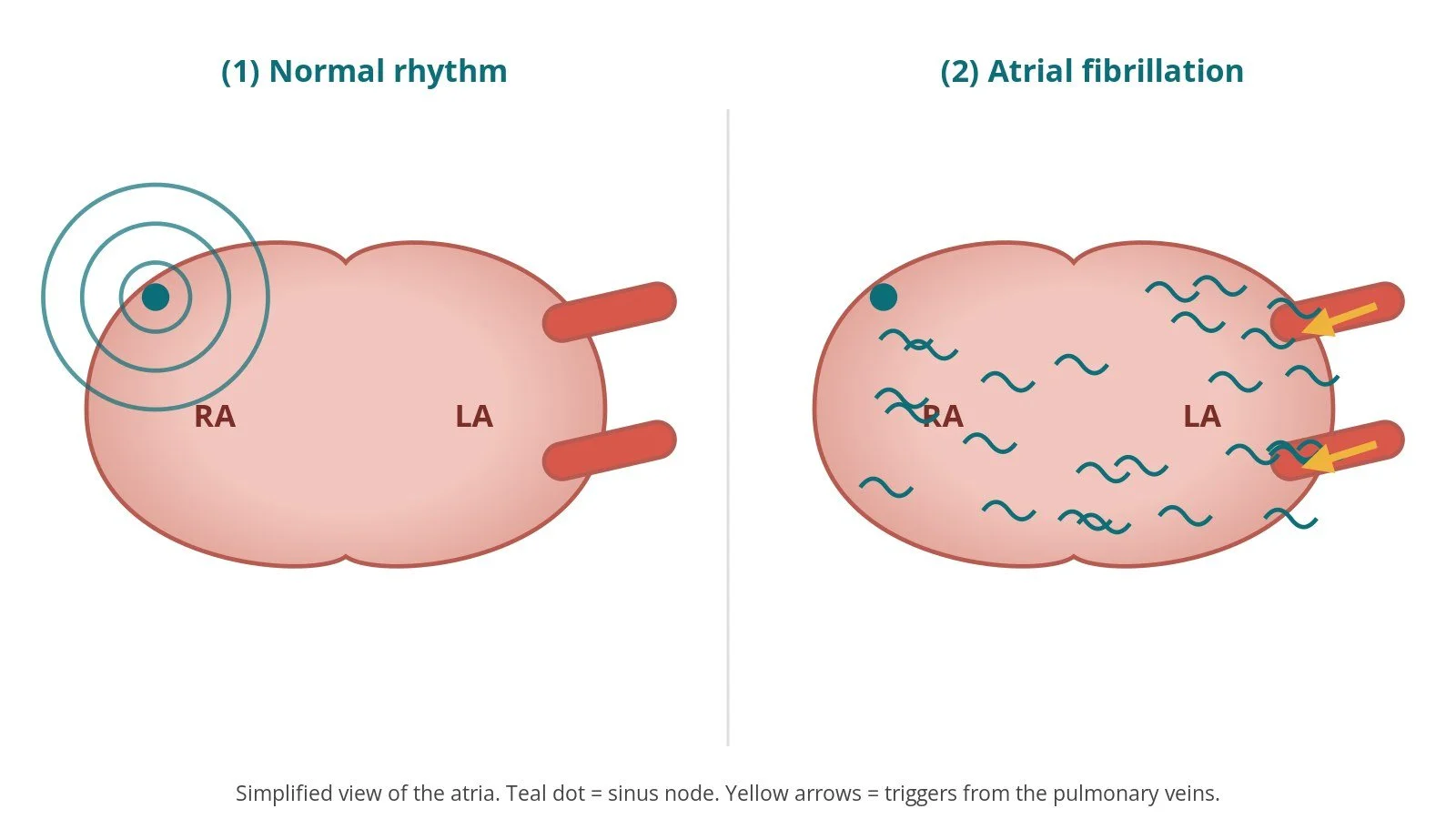 AF ablation (cryoablation and pulmonary vein isolation): a Cath Lab 101 guide
